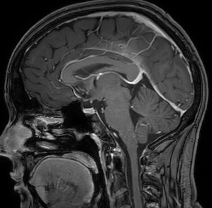 Cerebral arteriovenous malformation (Radiopaedia 74411-85654 Sagittal T1 C+ 65).jpg