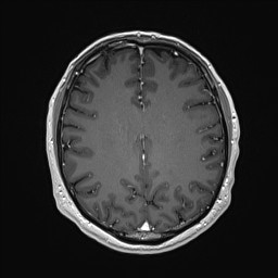 Cerebral arteriovenous malformation (Radiopaedia 84015-99245 Axial T1 C+ 102).jpg