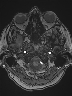Cerebral arteriovenous malformation (Radiopaedia 84015-99245 Axial TOF 53).jpg