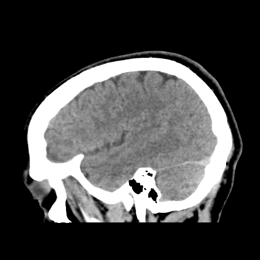 File:Cerebral arteriovenous malformation (Spetzler-Martin grade 2) (Radiopaedia 41262-44076 A 18).png