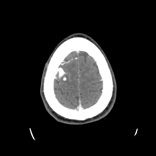 Cerebral arteriovenous malformation (Spetzler-Martin grade 2) (Radiopaedia 41262-44076 Axial C+ 45).png
