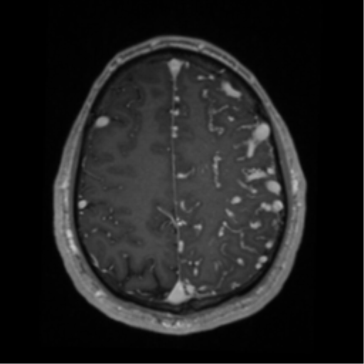 Cerebral arteriovenous malformation - huge (Radiopaedia 35734-37272 Axial T1 C+ 57).png