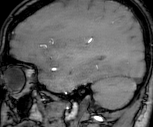 Cerebral arteriovenous malformation at posterior body of corpus callosum (Radiopaedia 74111-84925 J 295).jpg