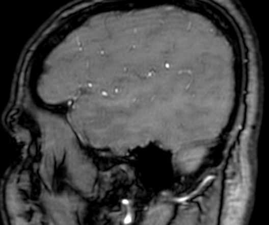 Cerebral arteriovenous malformation at posterior body of corpus callosum (Radiopaedia 74111-84925 J 48).jpg