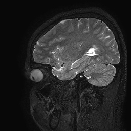 Cerebral arteriovenous malformation at posterior body of corpus callosum (Radiopaedia 74111-84925 Sagittal T2 33).jpg