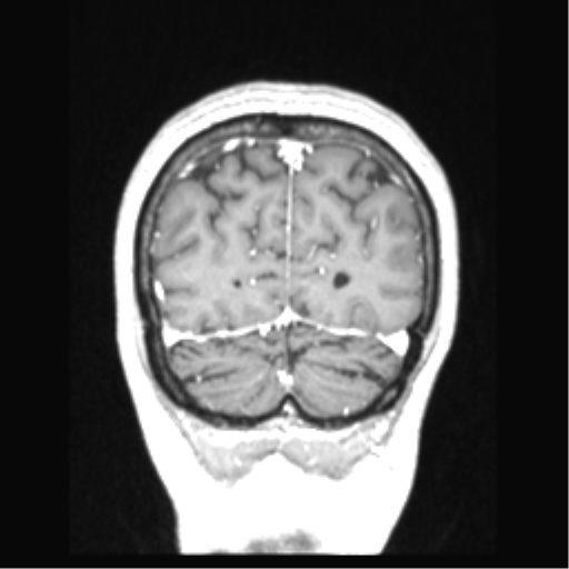 Cerebral arteriovenous malformation with hemorrhage (Radiopaedia 34422-35737 Coronal T1 C+ 18).png