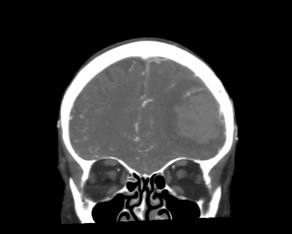 Cerebral arteriovenous malformation with lobar hemorrhage (Radiopaedia 44725-48511 A 15).png