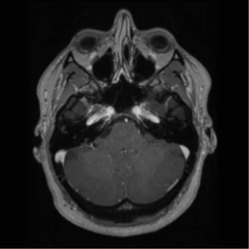 File:Cerebral cavernoma and development venous anomaly (Radiopaedia 37603-39482 Axial T1 C+ 19).png