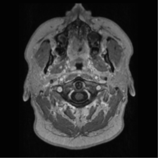 Cerebral cavernoma and development venous anomaly (Radiopaedia 37603-39482 Axial T1 C+ 2).png
