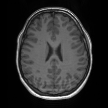 Cerebral cavernous venous malformation (Radiopaedia 70008-80021 Axial T1 49).jpg