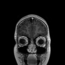 Cerebral cavernous venous malformation (Radiopaedia 70008-80021 Coronal T1 C+ 53).jpg