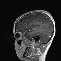 Cerebral cavernous venous malformation (Radiopaedia 70008-80021 Sagittal T1 C+ 55).jpg