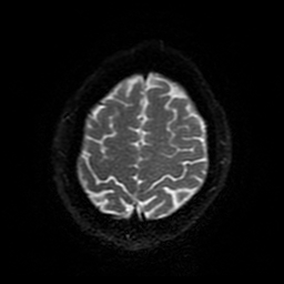 Cerebral cavernous venous malformation (Zabramski type II) (Radiopaedia 85511-101198 Axial DWI 92).jpg