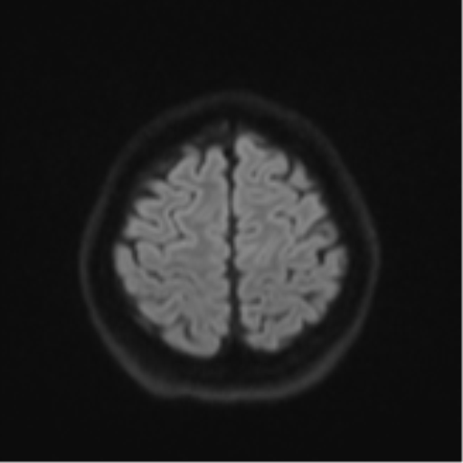Cerebral cavernous venous malformations (Radiopaedia 48117-52946 Axial DWI 51).png