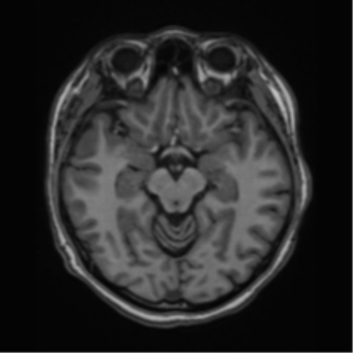 File:Cerebral cavernous venous malformations (Radiopaedia 48117-52946 Axial T1 12).png