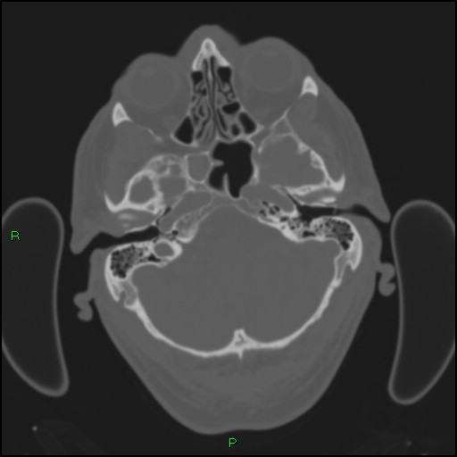Cerebral contusions (Radiopaedia 33868-35039 Axial bone window 36).jpg