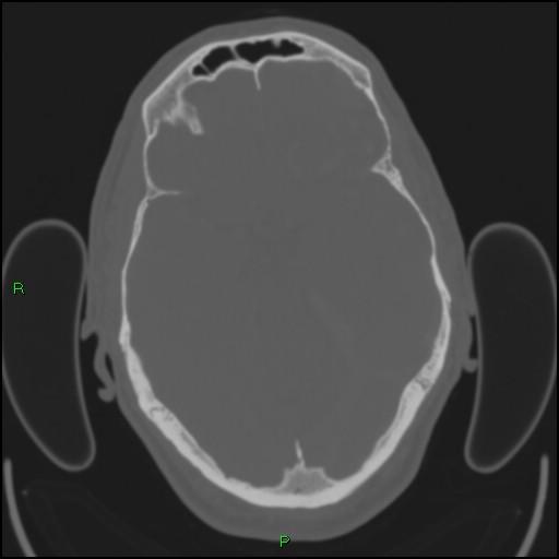 Cerebral contusions (Radiopaedia 33868-35039 Axial bone window 75).jpg