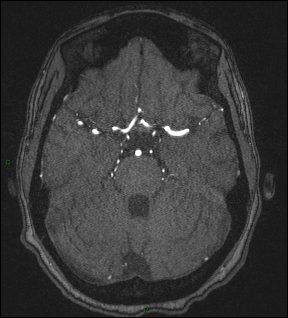 Cerebral fat embolism (Radiopaedia 35022-36525 Axial TOF 67).jpg