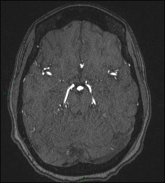 Cerebral fat embolism (Radiopaedia 35022-36525 Axial TOF 77).jpg