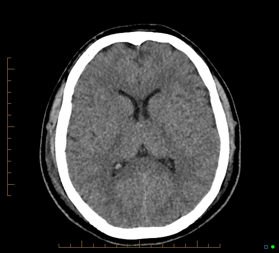 Cerebral fat embolism (Radiopaedia 85521-101224 Axial non-contrast 28).jpg