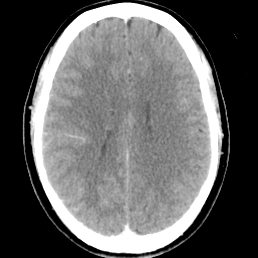 Cerebral hemorrhage secondary to arteriovenous malformation (Radiopaedia 33497-34561 B 34).png