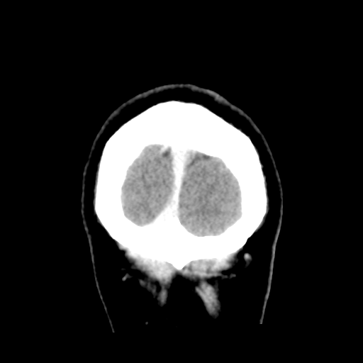 Cerebral hemorrhage secondary to arteriovenous malformation (Radiopaedia 33497-34561 C 63).png