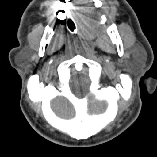 Cerebral hemorrhagic contusions and cervical spine fractures (Radiopaedia 32865-33841 F 10).jpg