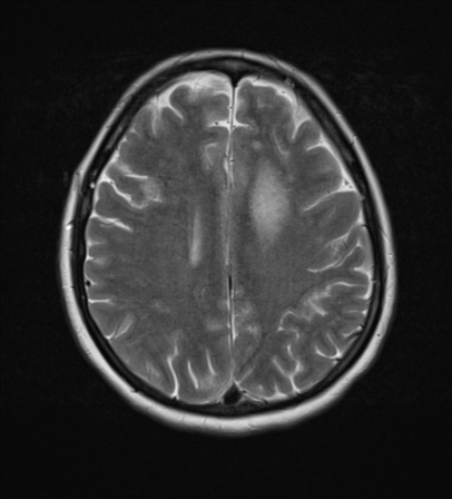 File:Cerebral metastases mimicking abscesses (Radiopaedia 45841-50131 Axial T2 20).png