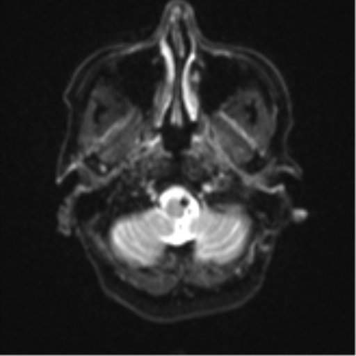 Cerebral metastasis (Radiopaedia 46744-51248 Axial DWI 3).png