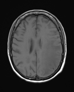 File:Cerebral metastasis (Radiopaedia 46744-51248 Axial T1 18).png