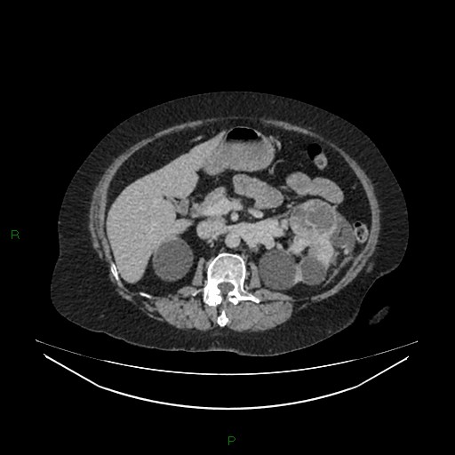 Cerebral metastasis from renal cell carcinoma (Radiopaedia 82306-96378 A 66).jpg