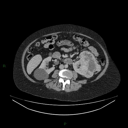 Cerebral metastasis from renal cell carcinoma (Radiopaedia 82306-96378 A 92).jpg