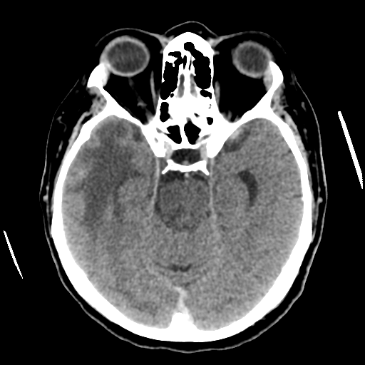 Cerebral metastasis to basal ganglia (Radiopaedia 81568-95412 Axial C+ delayed 23).png