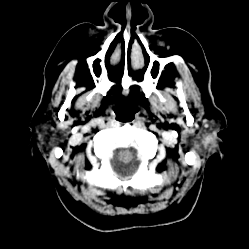 Cerebral metastasis to basal ganglia (Radiopaedia 81568-95412 Axial C+ delayed 8).png