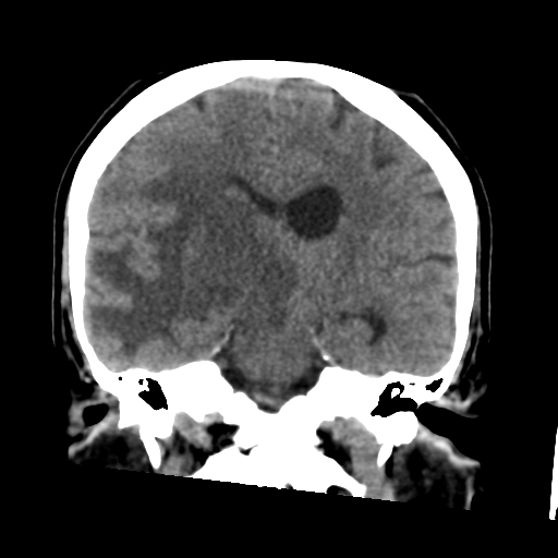 Cerebral metastasis to basal ganglia (Radiopaedia 81568-95412 Coronal non-contrast 38).png