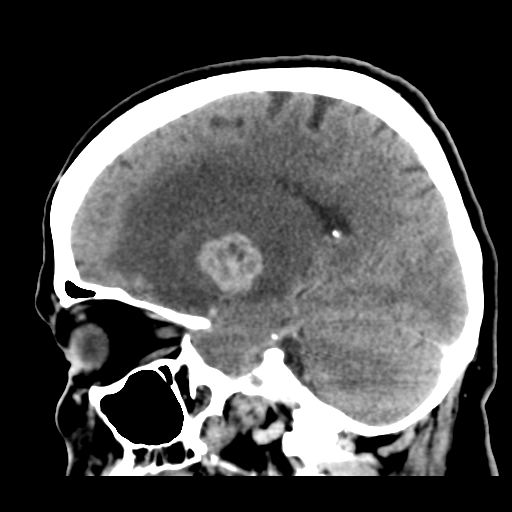 Cerebral metastasis to basal ganglia (Radiopaedia 81568-95412 Sagittal C+ delayed 23).png