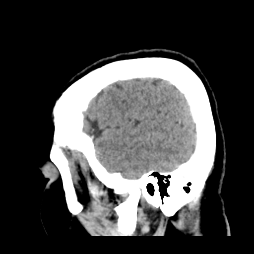 File:Cerebral metastasis to basal ganglia (Radiopaedia 81568-95412 Sagittal C+ delayed 47).png