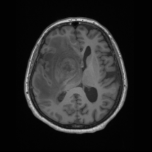 File:Cerebral metastasis to basal ganglia (Radiopaedia 81568-95413 Axial T1 39).png