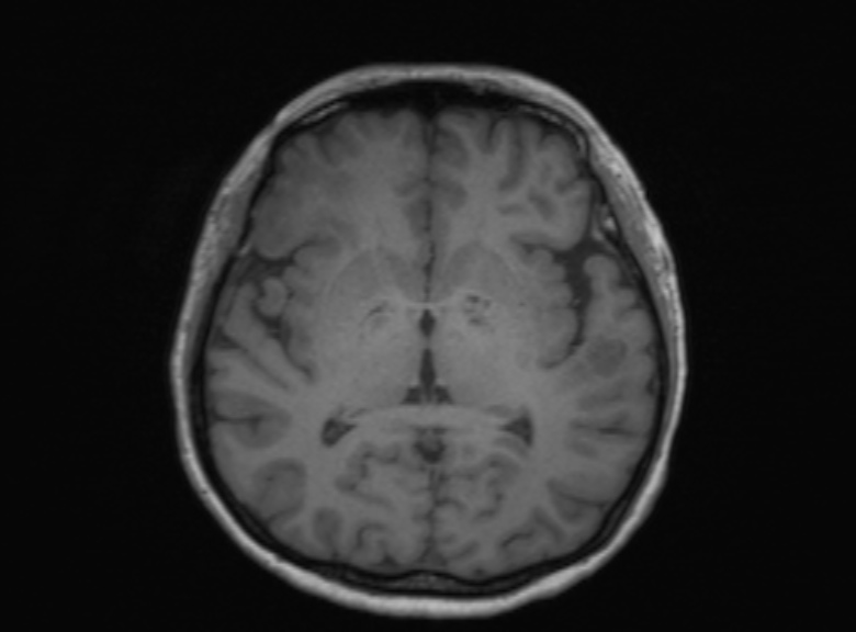 Cerebral ring enhancing lesions - cerebral metastases (Radiopaedia 44922-48817 Axial T1 229).jpg