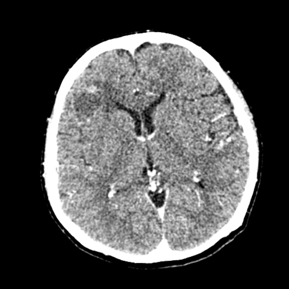 Cerebral ring enhancing lesions - cerebral metastases (Radiopaedia 44922-48818 B 151).jpg