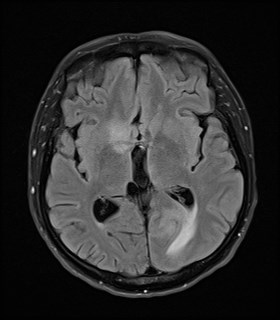 File:Cerebral toxoplasmosis (Radiopaedia 43956-47461 Axial FLAIR 11).jpg