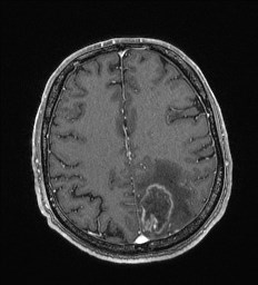 Cerebral toxoplasmosis (Radiopaedia 43956-47461 Axial T1 C+ 53).jpg