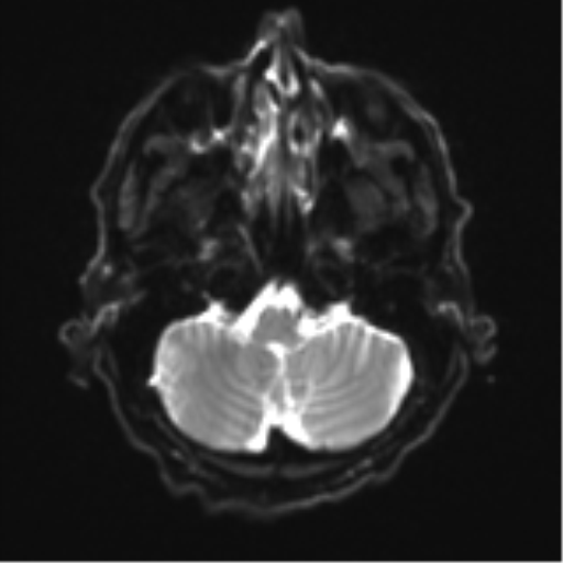 Cerebral toxoplasmosis (Radiopaedia 54575-60804 Axial DWI 8).png