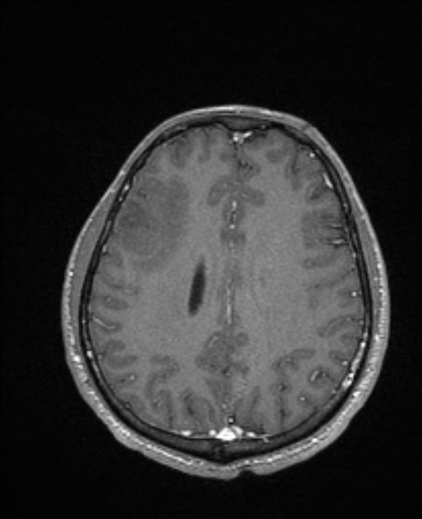 Cerebral toxoplasmosis (Radiopaedia 85779-101597 Axial T1 C+ 112).jpg