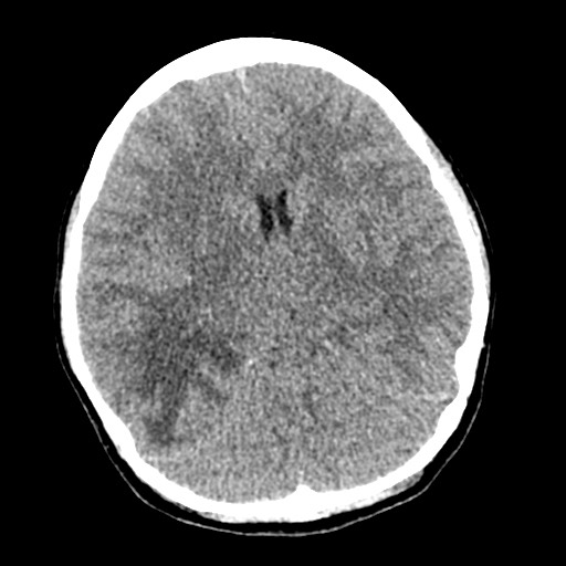 File:Cerebral tuberculosis with dural sinus invasion (Radiopaedia 60353-68018 Axial non-contrast 26).jpg
