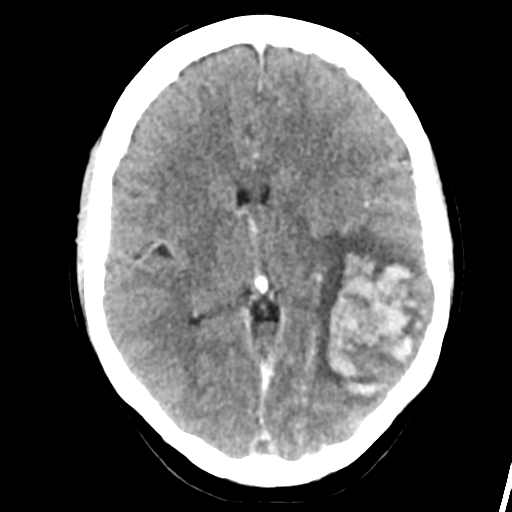 Cerebral venous hemorrhagic infarction (Radiopaedia 57576-64538 Axial C+ 24).png