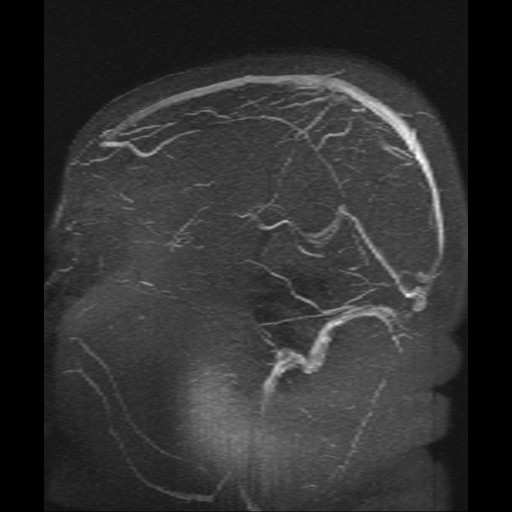 Cerebral venous infarction (Radiopaedia 25109-25396 MRV 3).jpg