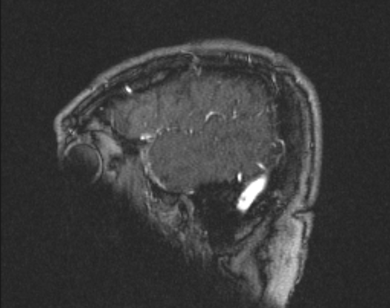 Cerebral venous infarction (Radiopaedia 65166-74176 Sagittal TOF 63).jpg
