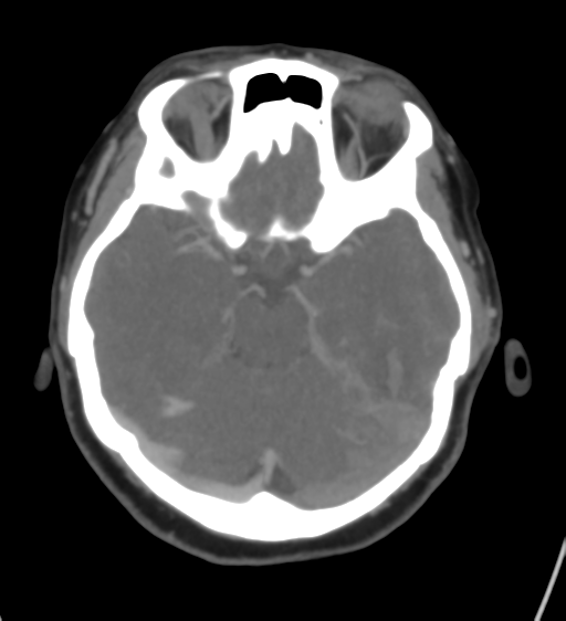 Cerebral venous infarction due to transverse sinus thrombosis (Radiopaedia 34688-36120 Axial CT venogram 20).png