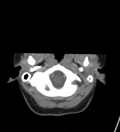 Cerebral venous infarction due to transverse sinus thrombosis (Radiopaedia 34688-36120 Axial CT venogram 7).png